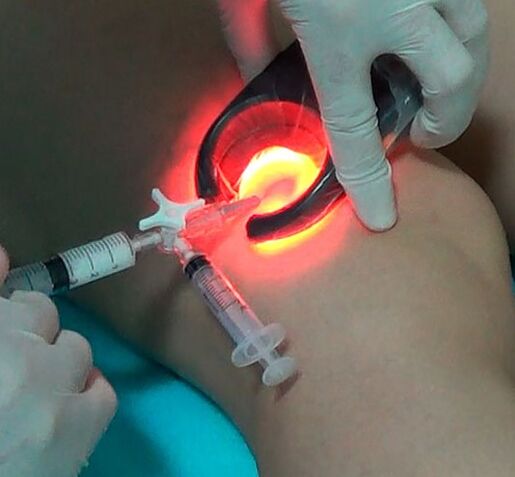 Varicose veins