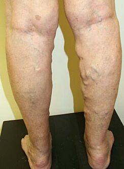 varicose veins
