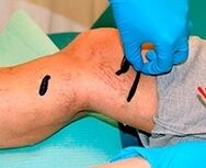 Leeches for varicose veins