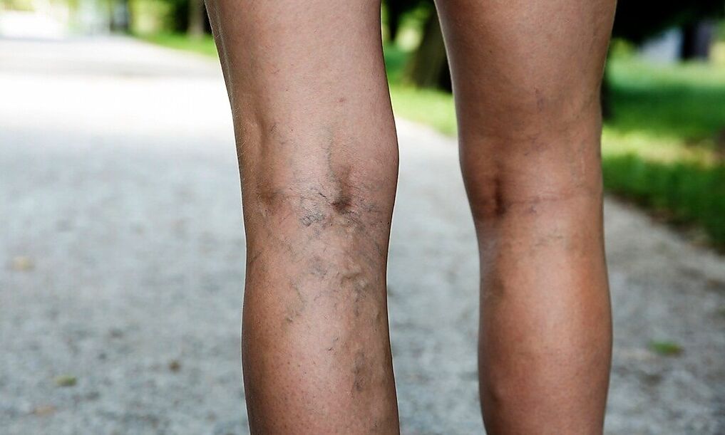 Varicose veins