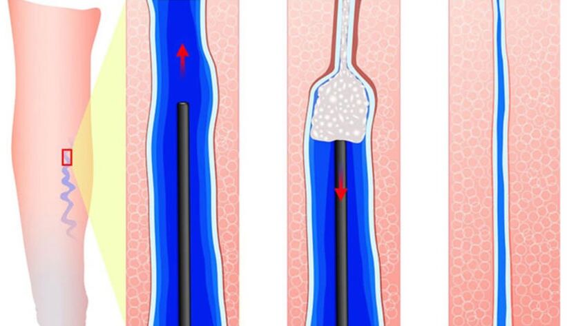 Introducing a sclerosant into sclerotherapy