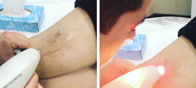 Laser treatment