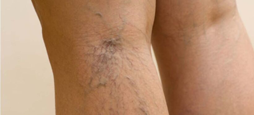 Varicose veins
