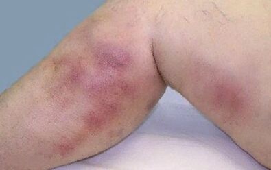 How varicose veins are manifested