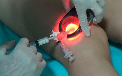 sclerotherapy as a way to treat varicose veins of the legs