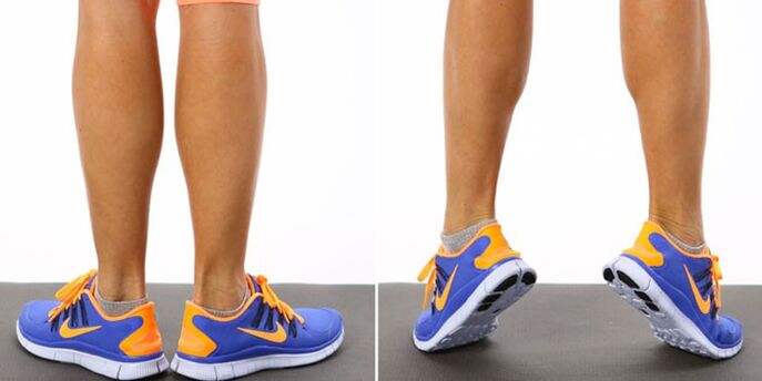 Varicose veins
