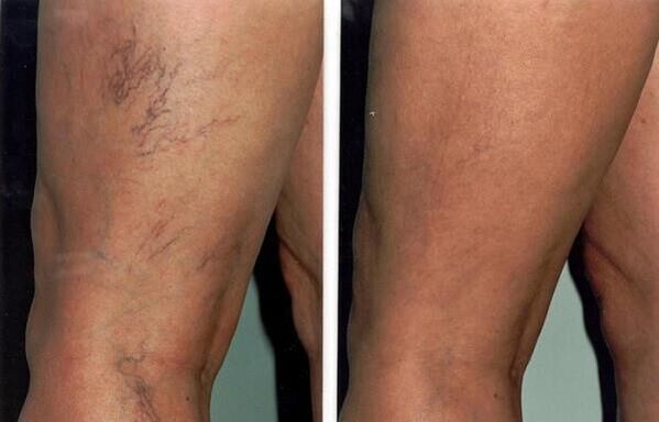 pictures before and after treatment of varicose veins