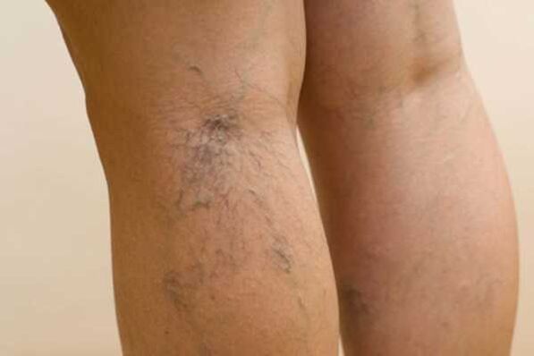 varicose veins of the legs