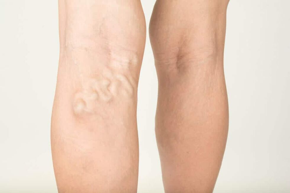 varicose veins
